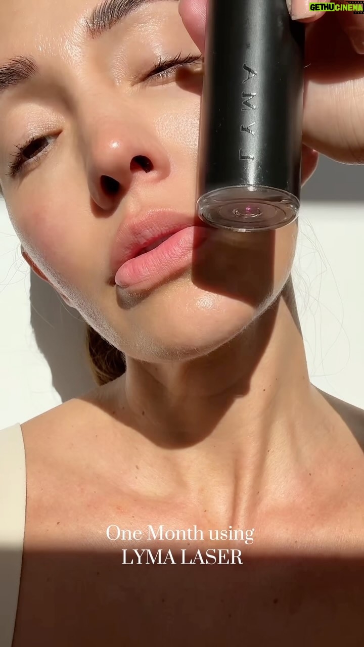 Fernanda Romero Instagram - 🙌🏼 So, did the LYMA laser work? You tell me... no Botox for 9 months! While pregnant, I couldn’t do much, but I used the LYMA laser. I started receiving more and more compliments about my skin. This is after just one month using the @lymalife laser! Yes, it WORKS. I wanted to make sure, since it’s an expensive machine, that it really worked, and I see results. Now, consistency is key, and be patient because you will see results. Enjoy this OFFER NOW: if you buy a LYMA Laser, you will receive the gift of LYMA Skincare (worth $525) for free! This offer is running from 17th May to 31st May in the US only. Enjoy, guys! ♥️