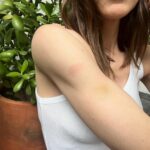 Irene Azuela Instagram - Me quemé. Me pegué.