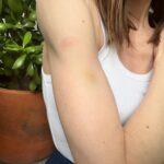 Irene Azuela Instagram - Me quemé. Me pegué.