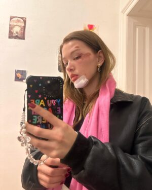 Jessica Alexander Instagram - gna keep it real Vienna was great but I also face planted off a lime scooter and got stitches 🫶🏼 so in the interest of transparency plz enjoy these pics of me serving with a face wound. & in the words of Alfred Pennyworth, why do we fall Bruce? So we can learn to pick ourselves up 🤝🏼🫡