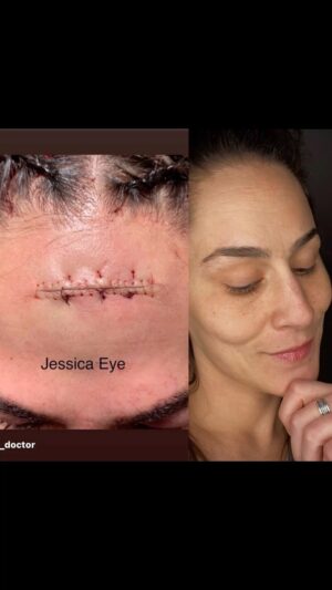 Jessica Eye Instagram - I hope everyone had a wonderful Easter Sunday🐇🙏🏼❤️ 

 This past year has had so many blessings good and bad 😂 I am happy to count my blessings on a daily basis and reminding myself that scars do heal. If you need a visual reminder for extra motivation. 😵 😂  at times its just as simple as looking in the mirror and Smile 😍

Two stitches on the  inside and 17 on the outside ! 
You know I Handled it like a champ too didn’t I @keebleristinyxoxo  If you seen the fight it was intense and bloody. 

Scars do heal 
.
. Thank you @the_ufc_doctor 🥼🩺
.
#ufc #jessicaevileye #retired