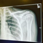 Keegan Connor Tracy Instagram - So the good news is… I don’t need surgery. The bad news is, this shoulder is fkd again. But really, in this moment, I just want to lay down some gratitude for the people working in hospitals right now. I was so grateful to get in and out in under three hours, to get the shoulder shot 💉💥 and the medications I need to get this stupid, chronic injury better. I’m grateful for the kindness of the staff and the ER’s Dr. Clark who was so great with me. Even more grateful to walk away with nothing more than an $18 bill for a shoulder sling. I’m so fortunate to live in a country with universal health care. Guess my Muay Thai days are officially over? #thisdamnedshoulder #impingement #shoulderrehab #healthcareworkers