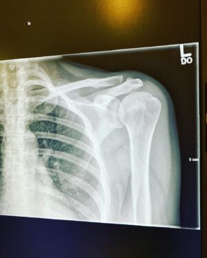 Keegan Connor Tracy Instagram - So the good news is…
I don’t need surgery. The bad news is, this shoulder is fkd again. 
But really, in this moment, I just want to lay down some gratitude for the people working in hospitals right now. I was so grateful to get in and out in under three hours, to get the shoulder shot 💉💥 and the medications  I need to get this stupid, chronic injury better. I’m grateful for the kindness of the staff and the ER’s Dr. Clark who was so great with me. Even more grateful to walk away with nothing more than an $18 bill for a shoulder sling. I’m so fortunate to live in a country with universal health care. 
Guess my Muay Thai days are officially over?
#thisdamnedshoulder #impingement #shoulderrehab  #healthcareworkers