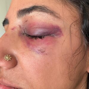 Kiran Deol Instagram - TW: Assault
Friends. I normally try to keep it light on here. But Friday night I was attacked unprovoked, by a random man outside a 7-11 when walking back from @lolowinebar with my friend @ericafishman. Super scary. 

People have been asking if it was a hate crime? I’m not sure. I was the only brown person around and he was a white dude. But he also seemed unwell. 

Police apprehended him; @ericafishman was amazing, doctors have been awesome, and even though LA gets a bad wrap, a bunch of strangers got me ice   were super kind and helpful. 

Im still shaken and processing. I have fractures and need some surgery as a result. The status of how long this will take is unknown atm. So as you go about your holidays, please stay safe and be vigilant.

Now if you see me wearing sunglasses at night, you know why. 

Finally, in true comedian fashion, please swipe for three ‘lewks.’ Nude, pirate, and diva. You know what app you're on. 

Also, nbd, but I got a shoutout on the Citizen app as ‘woman.’ Pretty chic. 

Take care this holiday season.  I love you. 💗