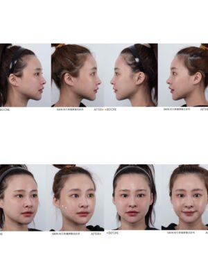 Lin Hana Instagram - 上次跟大家分享的鳳凰🐦‍🔥🐦‍🔥一個月後的before/after
每個人看完都超！級！心！動！的！真的非常推薦！
😝這篇是三個月後惹😝
朋友已經約這個禮拜打完了！除了痛，忍忍就過了！
先打就先漂亮囉寶寶綿😝
雖然價錢不便宜，不過一般人如果沒有像模特兒每天要拍照表情喜怒哀樂做個三千回以上外加外拍艷陽曬的！可以撐個1.5～2年是非常划算的療程喔！隨著膠原蛋白增生，大約三到六個月效果會最明顯！
可以給大家參考！我自己大約一個月就蠻有感的😁鳳凰老手4我🤪
除了輪廓線加強，年紀增長脖紋也不會給你少長，人家說看年紀就看脖子！ok～～醫生麻煩也幫我加強一下脖子！謝謝😚
看我的臉整個小一號好像瘦了4公斤但其實沒有！
就只是下垂亂降落ㄉ肉肉們回家歸位變緊實了！
我是給 @iskinbeautyclinic 王麒惠醫師治療的~
可以直接打電話到診所預約諮詢唷！護士都超漂亮😜
以上給各位水水們參考💕💕💕