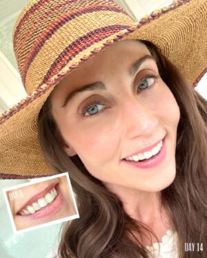 Mary Padian Instagram - Toodle-oo Teeth Stains & Hello There Pearly Whites!

Friends, I'm here to tell you about my Remi Custom Teeth Whitening Kit! @remitribe I've been using it for 2 weeks now and been LOVING the results (see before & after photo)!

I used to buy teeth whitening strips but they made my teeth and gums so irritated and sensitive. A friend recommended Remi’s kit because their whitening gel is made of high quality vegan ingredients & is safe for overnight wear. So, I had to try it and I'm so glad I did. 

The process was super easy - I ordered online, did an impression kit from home, and the Remi team sent me back ultra-comfortable custom teeth whitening trays with plenty of gel. Then, before getting into bed I put a thin layer of whitening gel in the trays and I’d forget they were there by the time I fell asleep. 

The Remi custom whitening kit brightened my teeth better than any other method that I’ve tried and I didn’t experience any tooth sensitivity. I am so happy with the results and couldn’t recommend it more. 
 
Go to shopremi.com and use code: MARY25 at checkout for 25% off today. This special offer is only available until Sept 25th! You’ll thank me later! Link in bio! 

#sponsored #remi #shopremi #teethwhitening #marysfinds #teeth #whiteteeth #covid_19 #smile  #smilemakeover #oralhealth #whitening #pearlywhites #teethwhiteningkit #whitesmile