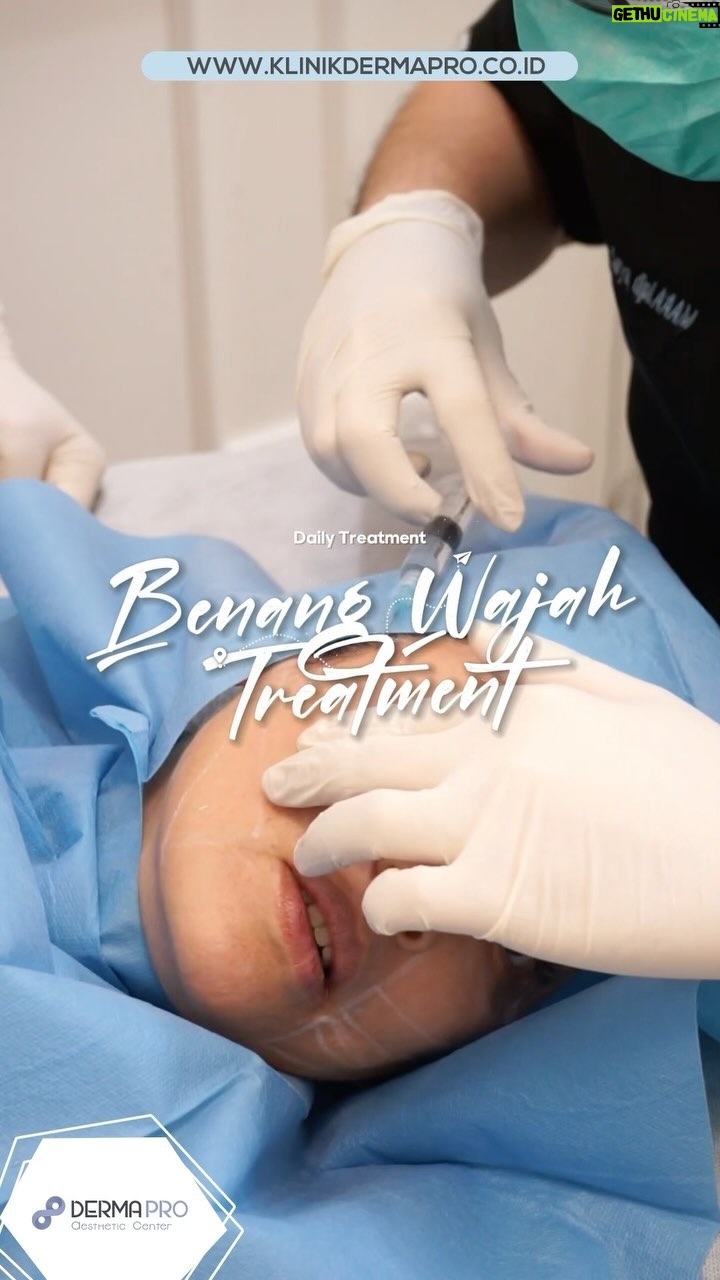 Meriam Bellina Instagram - Treatment Tarik Benang dengan inovasi terbaru di @klinikdermaprojakarta ? Apa si beda nya dengan benang yang lain? - Benang terbaru denga tarikan yang lebih kencang dan awet tahan lebih lama - Benang di desain sesuai dengan bentuk wajah sehingga tidak mudah putus - Menggunakan teknik terbaru sehingga pasien akanmendapatkan hasil yang jauh lebih maksimal 📞 Phone: 021 567 0627 Whatsapp 1: 0878 8541 8969 Whatsapp 2: 0819 0506 3853