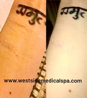 Michelle Borth Instagram - What is “Roll Up Your Sleeves”? Roll Up Your Sleeves is a movement dedicated to those who are suffering the physical scars from mental illness including, self harm, NSSID, drug abuse, and suicide attempts. Many people find it difficult to move forward from the stigma attached and the constant reminders branded on their bodies. We would like to offer a solution, free of cost, to anybody suffering in silence.  Your struggle does not define you, and neither do your scars.
	I have proudly partnered up with renowned cosmetic surgeon, Doctor Alexander Rivkin, to launch our new campaign Roll Up Your Sleeves, in support of Mental Health Awareness. Roll Up Your Sleeves is an organization designed to help instill confidence and hope to those who suffer with the physical scars from their battle with mental illness, by offering a non-invasive, non-surgical procedure to help diminish the appearance of scars.  Dr. Rivkin will be providing this self-created procedure completely pro-bono.  His abilities to erase scars that stand as a constant reminder of one’s past, can help a person tremendously move forward on the path to healing and well being. I understand the reality that not everybody can afford the cost of treatment, or may be ashamed to even look for solutions, and this is why we created Roll Up Your Sleeves.  I’m so proud to be working with Dr. Rivkin, who is donating his time and expertise, to offer this service at no cost to those in need. Roll Up Your Sleeves is dedicated to help as many people possible put their past behind them, feel confident, and hopeful again. This has been a labor of love of mine for years, Dr. Rivkin and I are so grateful for the enormous amount of support and love we’ve received in just the last 24hrs from all over the world. We are currently working on the website to make it a fully functioning site that will serve as a space for community, support, compassion, and informative resources. Please bare with us while it's under construction. You can still go to the site and subscribe or if you’d like to make an appointment to see Dr. Rivkin please go @westside_aesthetics or call (310) 443-5273.	
#nostigma #mentalhealthawareness #drrivkin