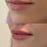 Olivia Kippen Instagram - I’m obsessed with my lips 👄 I have had my lips filled three times and I only let the best and only, @triciavermilya_aesthetics to touch them 🥲 Thank you for making them ✨plump & perfect✨