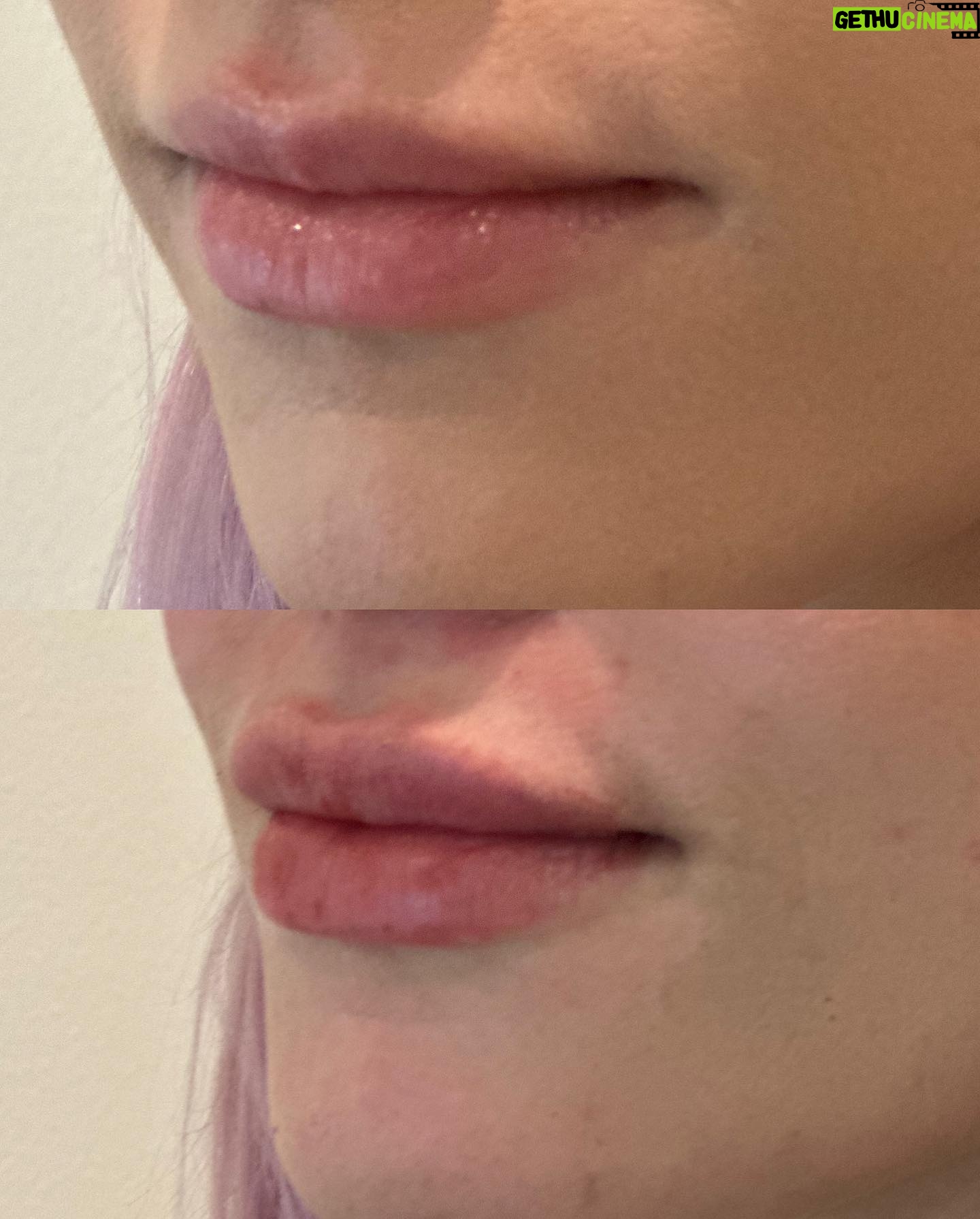Olivia Kippen Instagram - I’m obsessed with my lips 👄 I have had my lips filled three times and I only let the best and only, @triciavermilya_aesthetics to touch them 🥲 Thank you for making them ✨plump & perfect✨