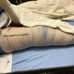 Peyton Evans Instagram – Well here is an update on my lovely knee journey. 
In attempts to tryout for cheer for next season I injured my knee again. I had surgery AGAIN! Friday the docs went in and completely removed my ACL, removed a cyclops lesion under my kneecap, repaired my MCL, released my PCL and shaved my kneecap to allow range of motion. I’ve been put in a full cast for 3 weeks to keep my leg in a straight position. The recovery time is 6-9 months with intense physical therapy. Definitely not what I expected! I have a long road ahead of me. 
#peytonkaye #kneeinjury #kneesurgery #thisdefinitelysucks
