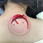 Pile Instagram - . 4枚目、5枚目は苦手な人はみないでね！🩸 １枚目はカムフラージュです。笑 久しぶりに先生に瘀血治療してもらいました✨ . @ishii_yukio ピラティス続けているので肩も大分よくなってたけど、やっぱり久々で瘀血が3回も出ました🩸🤣 チクッくらいで全然痛くないんだよ🤣 瘀血って痛いところとか手術してあまり動かないところなどにとどまるとのこと。 前日ピラティスでしごかれたのですが違うからだの痛みがあって、先生に治療院してもらってマッサージもしてもらったら痛みはとれてちゃんと筋肉痛だけ残りました🤣笑 頬の圧出した時に残った傷跡にも鍼を施してくれて固くなってた部分が平らになったよ。 お母さんはわたしの次だったんですが、お母さんもなかなかの。 血の塊はだしてあげた方がいいな、と毎回来て思ってます🤣 食事なども教えてくださるのでいい時間になってます😌おすすめだよー！！ #南麻布 #広尾 #石井治療院