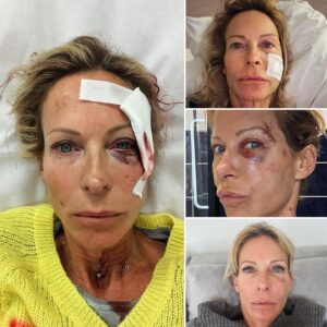 Rebecca Hampton Instagram - Il y a un mois je me faisais opérer après une très mauvaise chute de vélo…
Fractures du visage…
Merci à l’hôpital de la Timone, l’hôpital de la Conception, merci à mon entourage proche, particulièrement à Manou pour son soutien, à ma fille pour ses soins…
Je vais beaucoup mieux!
Petit conseil: 
AJUSTEZ BIEN VOS CASQUES! 🙏
#accident #opération #chance #fracture #sourire #amour