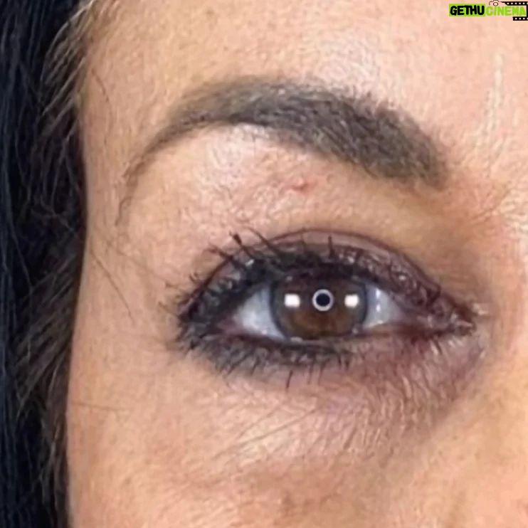 Rita Guerra - 2.4K Likes - Quando considerei fazer uma blefaroplastia, procurei exactamente o que se pode confirmar nas fotos: retirar o excesso de pele, sem exageros, de modo a abrir novamente o olhar mantendo a minha expressão natural.
Para isso dirigi-me à @clinicaonyx onde pude contar com a ajuda do @drdiogoribeiro.pt.
Após ver o resultado, o meu sogro decidiu fazer a mesma intervenção, uma vez que tinha as pálpebras muito descaídas sobre a vista.
Brevemente partilharei também as fotos dos olhos dele para que possam ver a diferença enorme .
Este é um problema que os homens têm mais que as mulheres e que chega a afectar a visão.
Cada vez mais os homens deixam os preconceitos para trás e procuram ajuda também a este nível.
Muito obrigada a todos na Clínica, bem como a toda equipa médica que assistiu à minha intervenção 🥰🤗