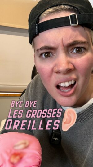 Roxane Bruneau Instagram - 🛑 ÂME SENSIBLE S’ABSTENIR 🛑

ByeBye les stretch ❗️
Bienvenue dans ma NEW ERA❗️

Ça fait 20 ans que j’ai des roues de bicycle à la place des oreilles, j’commence à avoir fait l’tour, j’ai envie de changement! J’en ai parlé avec @pamela.murphyclinique qui m’a rassuré en me montrant le CATALOGUE des chirurgie de lobes d’oreilles du @drgenevievefcaron . Il ne m’ent fallait pas plus pour me rassurer, elle fait des tabar*%# de beaux lobes 👂🏼

Fak me voila à la @cliniqueevolutionmtl en train d’me faire recoudre les stretch 🛞

Ps: La vidéo est DÉGUEULASSE 🤢 
Pps: J’suis pas payé c’pas une pub, c’t’un vlog 💰❌