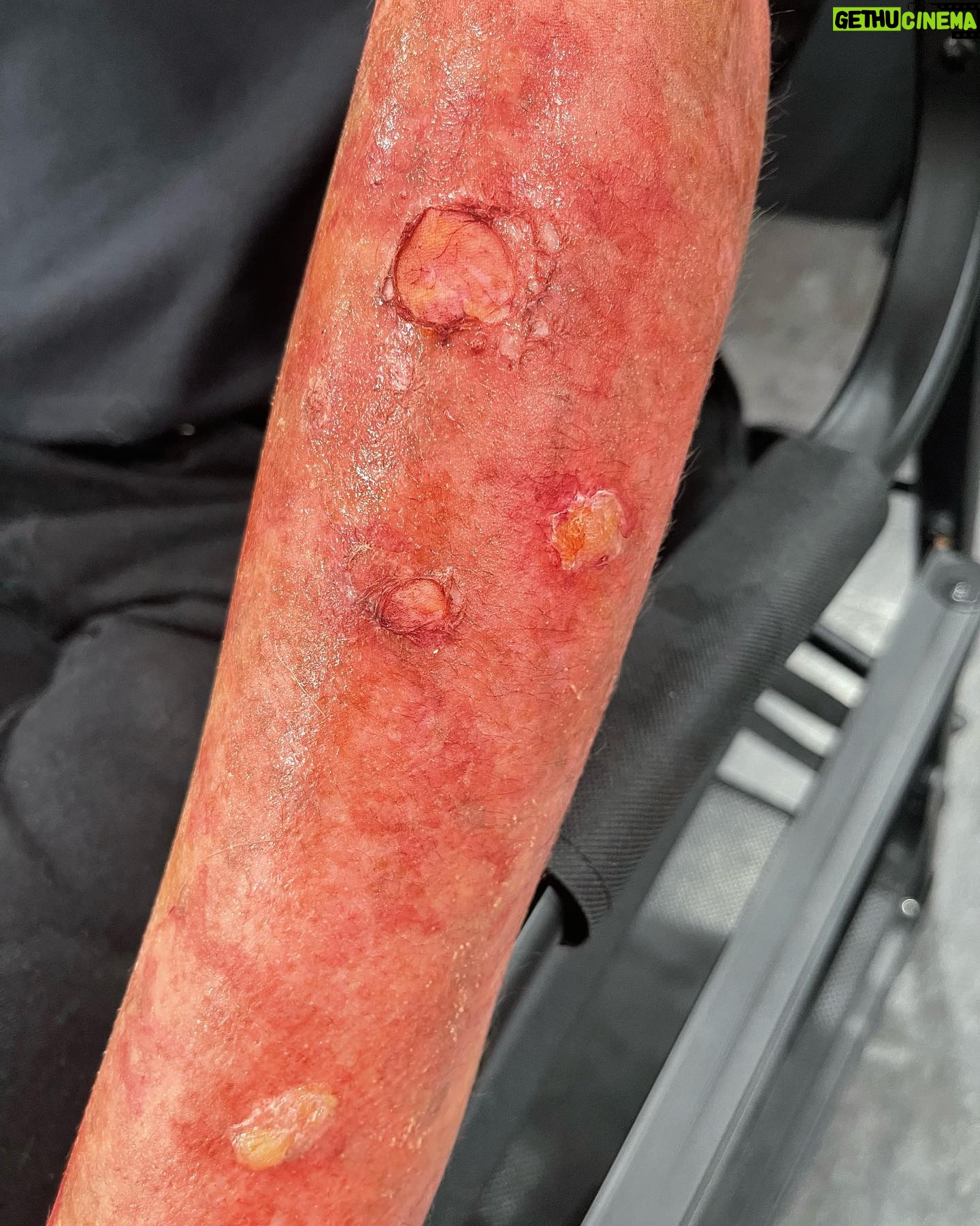 Ve Neill Instagram - Some demos I did for the trauma class @legendsmakeupacademy β¨ Sign up for Classes ππΌππΌππΌππΌ legendsmakeup.com β’β’β’β’β’β’β’β’β’β’β’ @legendsmakeupacademy @vesfavoritebrushes @therealve #makeup #specialeffects #specialeffectsmakeup #makeuptutorial #makeupartist #traumamakeup #veneill #legendsmakeup #fx #fxmakeup #sfxmakeup #sfx #mua #makeupmua