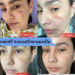 Vichuda Pindum Instagram - 💥Promotion ราคาพิเศษ หมดแล้วหมดเลย💥 . Kelosil 3 หลอด จากปกติราคา 2,900.- 💙พิเศษ 3 หลอด 999.-💙 พร้อมจัดส่งฟรี 👉🔴 ทักไลน์ wichudapindum 🔴 🔥🔥Promotion พิเศษฉลอง 20 ปี🔥🔥 Kelosil ลดรอยแผลเป็น‼ เจลลดรอยแผลเป็นแบบ “ เคลือบ “ !!!! ท้าให้ลอง👍🏻💗 . สามารถทาที่ไหนได้บ้าง ❓ ✅ แผลคีลอยด์ ✅ แผลเป็น ✅ แผลพุพอง(ที่หายสนิทแล้ว) ✅ แผลผ่าตัด ✅ แผลที่เกิดจากสิว ✅ แผลนูนแดง ✅ แผลจากอุบัติเหตุ