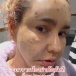Vichuda Pindum Instagram - #day2 #korea #ศัลยกรรม @daplasticsurgery_th