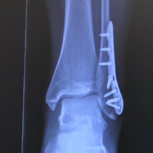 Xenia Goodwin Instagram - Hey guys, so I’ve been a bit quiet of late but here’s why... broke my ankle, and did a very good job of it! I tried very hard to get back to ballet training and didn’t do very well at it.  Couldn’t even balance, and that was my thing!  Today I had the overwhelming experience of going in to @bauerfeindaustralia.  They took a 360 degree image of my legs and ankle and set me up with some seriously good support.  Thanks Walid! ❤️ This is a nutty video of me balancing for the first time on a 3/4 pointe since last year.  It’s a phenomenal feeling.  Dancers... check these guys out at www.motionislife.com.au I could not recommend them more highly. 
#backtoballet #bauerfeindaustralia #gettingmyballetback #thankyou #motionislife 👊 ❤️