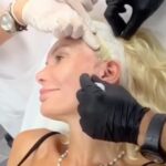 Yola Berrocal Instagram - Cris Oyola me pone hilos tensores, muy feliz con el resultado y sin dolor.