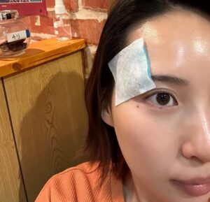 Yuka Masuda Instagram - ＊

先日舞台が終わったその足で駆け込み肌メンテ！
クタクタになったお肌を蘇らせていただきました🤩

フォルダに自撮りがなさすぎて久々に撮ってみたものの、物にぶつかって青たん出来てたのでよくこの写真を載せようと思ったな、くらいの雑な写真ですみません。ﾁﾘ🌶️

今回の舞台でみんなからお肌をほめてもらい😭💜ﾔｯﾀｰ
ご観劇いただいたお客さまからもお肌何してるの？！と聞かれたりと舞台中肌トラブルが起きやすい時期も乗り越えてくれる強い肌になりました！
月一でクリニックに行ってなかったらこんな風に言ってもらえてないと思う😭大感謝です！！

今回はシミ取り全顔とリジュラン！あとは毎回必ずやるメソナJ。
シミは気にならないと言ってもらいましたが、今回思い切って気になるところは全部やっちゃおう！ということでこまかーく全部に打ってもらいました。見事に黒胡麻煎餅🍘みたいになりましたが今は全部カサブタ取れてツルツル！

ということで心もお肌も大リセット。
金ピカピンに輝くお肌を目指して･:* .\(( °ω° ))/.: ✨
肌メンテテンションあがる〜！

・
・
・
#メソナj #リジュラン #シミ取りレーザー #美容 #美容マニア #美肌 #美肌ケア #肌ケア #肌荒れ #肌質改善 #ニキビケア #pr #表参道メディカルクリニック #表参道メディカルクリニック六本木院