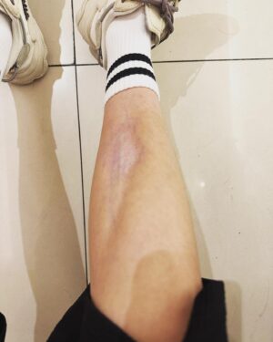 Yuto Lin Instagram - 0524
之前萎縮的腳的肌肉在日本步行萬哩之後終於長出來一點點
但還有好長的路要走💪
前兩天不知道誰竟然問我為什麼要把原子筆塗在腳上=.=
我說那是我的血管啦吼
生命的點點滴滴留下的足跡
不管好的壞的都會好好記得
這才是生活快樂的地方❤️
而且我竟然穿不同雙襪子現在才發現⋯⋯⋯⋯
99的新品準備上線值得期待💜💜