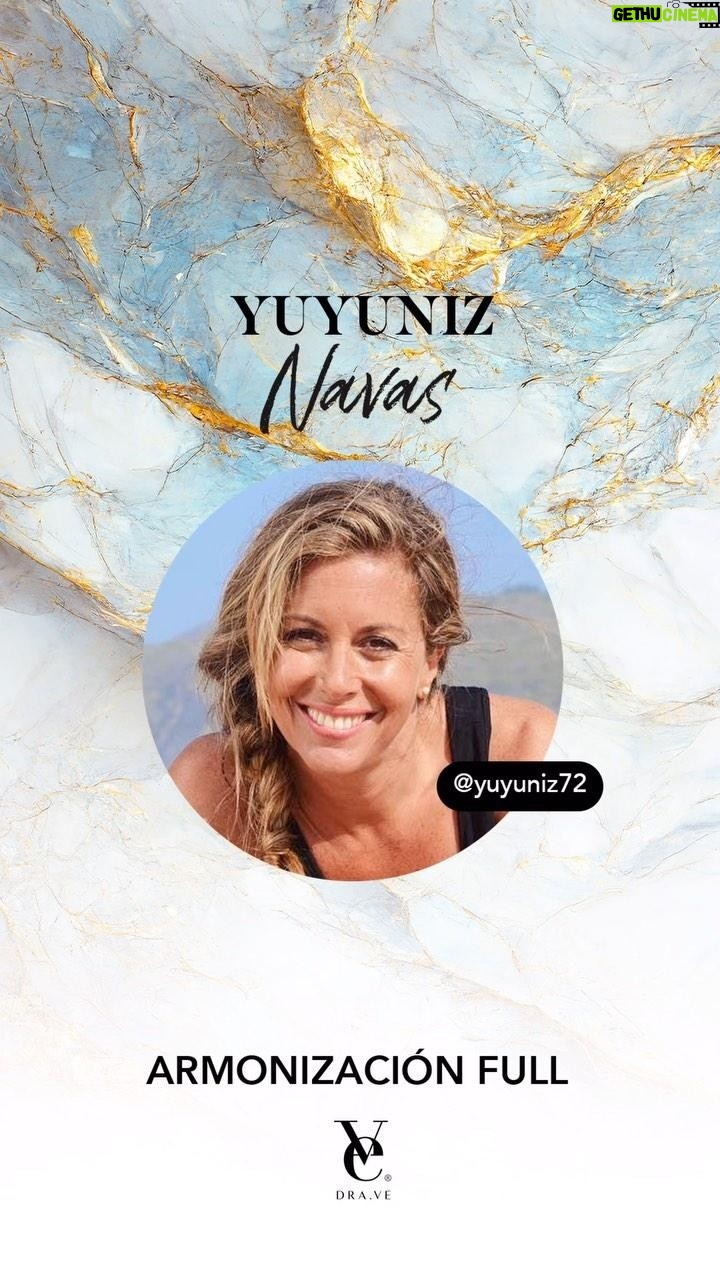 Yuyuniz Navas Instagram - Hermosa armonización full con nuestra @yuyuniz72 que confió plenamente en mi ❤️ Quería un tratamiento integral y natural para su rostro y así lo hicimos. Muchos pacientes tienen miedo de realizarse tratamientos estéticos por perder su naturalidad y esencia, por eso es tan importante ir a un profesional calificado, con experiencia y buen gusto, que pueda guiarte de la mejor forma. Una armonización siempre es por etapas y es distinto para todas las personas 🫶🏼✨ En este caso necesitamos mejorar varios puntos: 1️⃣Perdida de volumen. 2️⃣Perdida de elasticidad de la piel 3️⃣Deshidratación de la piel. 4️⃣ Tratar los surcos profundos que generan sombras en nuestro rostro, haciendolo lucir cansado.
La mayoría de las personas tienen miedo a quedar muy rellenados o con caras muy plásticas, pero créeme que en las manos adecuadas esto es muy difícil de conseguir. La belleza actual busca la naturalidad y lo armonioso. Los materiales actuales, y creo que siempre digo esta frase, son una joya de la tecnología, le devuelven a tu piel lo que va perdiendo con el tiempo. No esperes a ver los estragos de los años, el secreto siempre es la prevención y mantención 🙌🏼❤️ ¿Les gustó el caso? ¿Creen que quedó natural? ¿Pensarían que tiene 11 ml? ¡Los leo! #DraVe #ArmonizaciónFull #MedicinaEstetica #ArmonizacionFacial #FullFace #AcidoHialuronico #Botox #Fillers #TuMejorVersion #ToxinaButolinica #Colageno #bioestimuladores