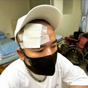 Ada Chang Instagram - 在這週拍完激烈的廣告和桃園觀光影片後
皮蛇找上門了.....那天越拍覺得眼窩和後腦
越來越痛 痛到吃了止痛藥都完全沒有作用

覺得應該不太單純 但收工太晚 直到隔天
一大早才去急診一下 原來我額頭神經節
長了帶狀皰疹 俗稱皮蛇 號稱生不如死....

止痛藥的消炎止痛基本上沒有用 因為是
神經紊亂產生的疼痛，所以醫生會開 抗憂鬱
和焦慮的藥 阻斷神經思考 降低痛苦
原本我一直以為皮蛇是皮膚病 哭原來是神經病

而因為長在頭部三叉神經 所以有失明及腦膜炎
的風險每天都要打針及吃特效藥 那個感覺
真的很像火燒 有人一直在我腦裡按電筆....
所以現在有皮蛇的疫苗建議大家都要打一下！

我真的每天Super開心無憂無慮  吃得好睡得飽
但還是中獎了 (還是每天吃什麼很大壓力？)
因為醫生說現在因為肺炎確診還有打疫苗 
真的會讓大家 免疫系統有點混亂 如果作息不正
心裡壓力太大 潛藏在你神經根部的病毒就會發作
是的！只要你有中過水痘 你的神經根部就一定
會有病毒 人體是無法完全消滅的 ！！！
也都會有復發機率 所以打疫苗吧！我要去當大使

一般50歲以上好發機率比較高，但如我所說的
因為時代的各種原因 年輕人比例也大大上升

所以千萬小心唷，好好注意免疫力 保持心情愉悅
工作不開心真的就罵他幹你娘囉 人生只有一次

現在只能中斷環遊世界ADA的爽哥生活 
好好放一個 大假 畢竟長在我俊美的臉上

希望我的家人朋友都能身體健康 永遠不要
發生這樣的病徵  一有不對立刻就醫
如果心裡有什麼壓力 也多多說出來
遠離皮蛇 你我有責！
#買只錶壓壓驚吧#不然有命賺沒命花