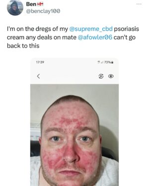 Anthony Fowler Instagram - THIS IS WHAT WE DO AT @supremecbd we GENUINELY vibes people theirs lives back and it’s ABSOLUTELY AMAZING to be apart from,  if you have PSORIASIS OR ECZEMA comment and I’ll give someone FREE @supremecbd cream 🙏🏻 GOOD LUCK 🤞🏻