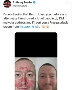 Anthony Fowler Instagram - THIS IS WHAT WE DO AT @supremecbd we GENUINELY vibes people theirs lives back and it’s ABSOLUTELY AMAZING to be apart from,  if you have PSORIASIS OR ECZEMA comment and I’ll give someone FREE @supremecbd cream 🙏🏻 GOOD LUCK 🤞🏻