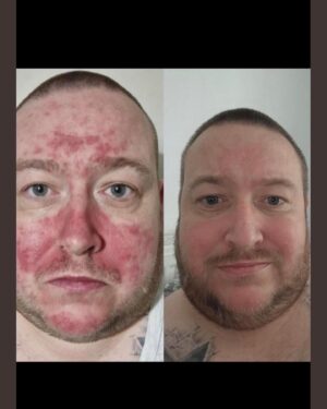 Anthony Fowler Instagram - THIS IS WHAT WE DO AT @supremecbd we GENUINELY vibes people theirs lives back and it’s ABSOLUTELY AMAZING to be apart from,  if you have PSORIASIS OR ECZEMA comment and I’ll give someone FREE @supremecbd cream 🙏🏻 GOOD LUCK 🤞🏻
