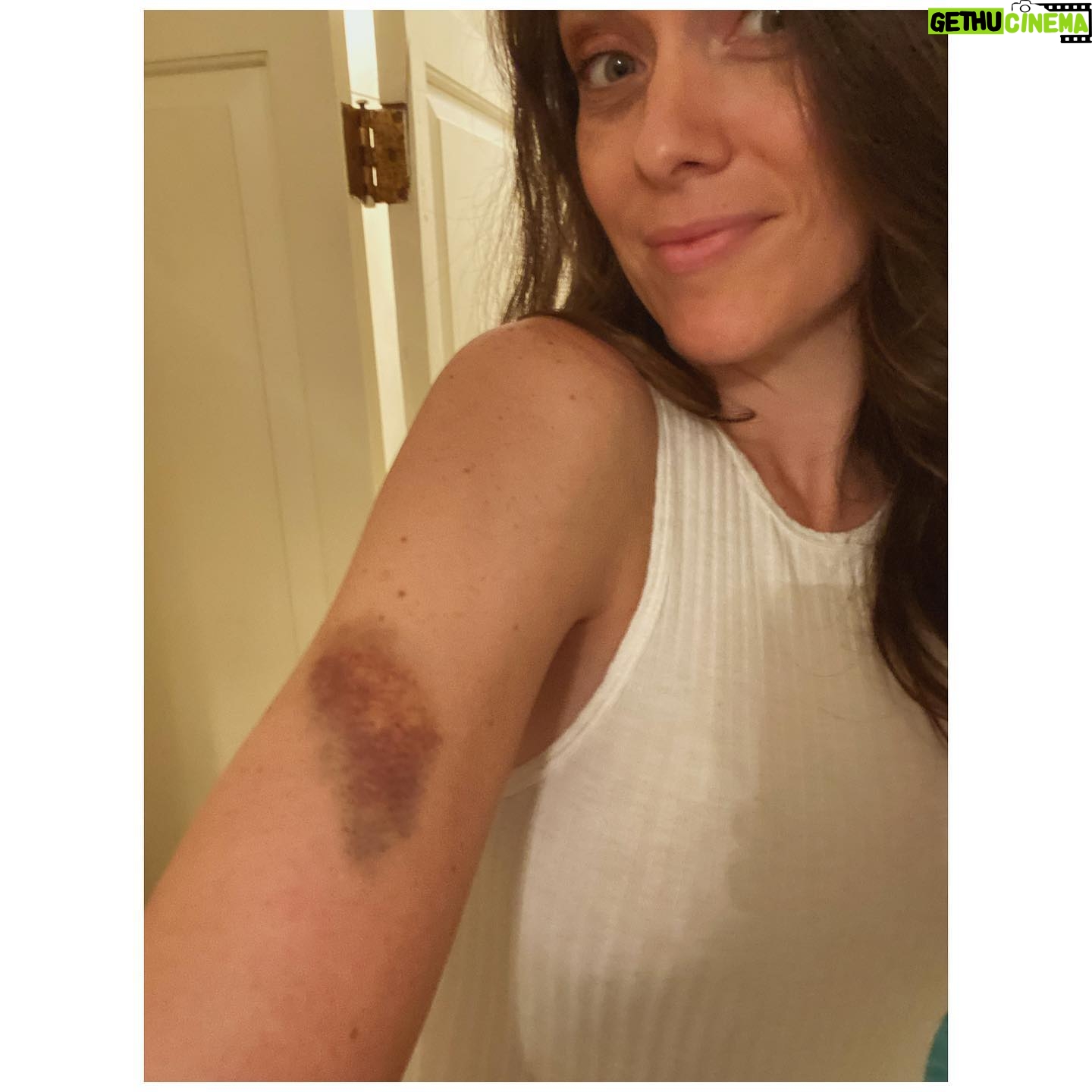 Ashlynn Yennie - 640 Likes - She bruises like a peach 🍑 Bruise is 💯 REAL. I may or may not have run into a car door while frantically searching for my fake son 😖 In my defense there was a gigantic hedge and light I had to avoid, and I successfully avoided both. Go Me. #methodactor #walkitoff #bruiselikeapeach