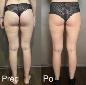 Barbora Balúchová Instagram - Keď to môže pomôcť ďalším ženám tak to s radosťou zverejním. ZVERILA SOM SA DO RÚK NAJLEPŠÍM🍑 
Celulitída… trápi vysoké % žien a u mňa aj napriek tomu že som schudla cvičím a snažím sa dobre stravovať bola veľmi viditeľná. ĎAKUJEM @viktoriamassage za to čo robíte a ste jednoznačne najlepšie🤍 Chodila som na maderoterapiu a rázovu vlnu a výsledok hovorí za všetko. Prosím vyberajte si naozaj profesionálne štúdia a nie také čo majú urobený kurz cez web. PS: Maderoterapia NEMÁ BOLIEŤ a NEMÁTE MAŤ MODRINY.