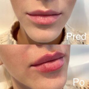Barbora Balúchová Instagram - Ďakujem @skinklinik.sk pani doktorke Martinke Hlavatej💋 pre niekoho kontroverzná téma ale myslím si že keď si žena dopomôže s citom a profesionálnymi službami výsledok je dokonalý. Žiadna kačička zo mna za tie roky čo si chodím napichat, hydratovať pery nieje a tým že mám extrémnu mimiku sme doplnili aj botox do čela. Ďakujem @skinklinik.sk a ženy nezabúdajte pri takýchto zákrokoch sa neoplatí vybrať to najlacnejšie lebo to nemusí dopadnúť dobre.