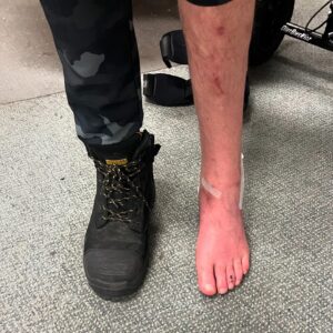 Blake Williams Instagram - 4 weeks down since some serious camber adjustment on the heel and a slight wheel alignment. All going well at this point, except the nightmares of Baltimore Dew tour 07 and eating shit doing someone that’s wasn’t necessary 🤦🏻‍♂️😂 hit up my #onlyFeet account for more VIP pics and private content 😂😂😂