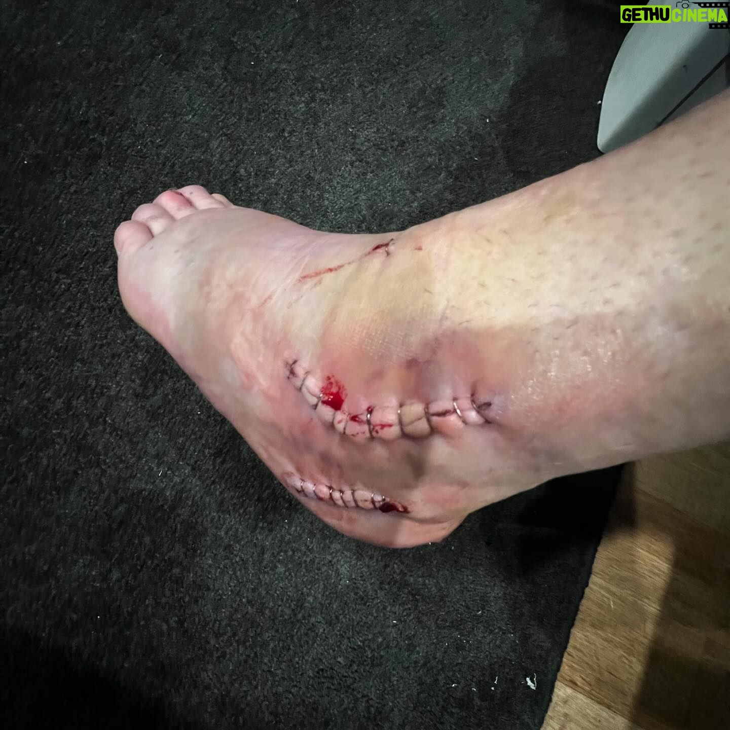 Blake Williams - 10.7K Likes - 4 weeks down since some serious camber adjustment on the heel and a slight wheel alignment. All going well at this point, except the nightmares of Baltimore Dew tour 07 and eating shit doing someone that’s wasn’t necessary 🤦🏻♂️😂 hit up my #onlyFeet account for more VIP pics and private content 😂😂😂