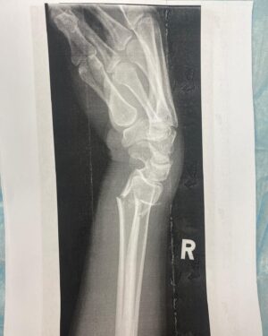 Brynley Stent Instagram - Hard launch of me and my broken wrist. We met in the winter of 2023 when I was writing at Shortland street and slipped on some wet grass while playing the fool 🤡. Huge thanks to the real nurse @_aliswan_ , and fake nurses at Shorty for looking after me after I fainted, and to all the actual medical staff at Waitakere and AKL hospitals for being legends even when royally understaffed. Loved the free nangs A  . Special shout out to my ride or die @chrisparker11 for being by my side the whole time and distracting me while two men literally pressed and pulled my wrist into place.