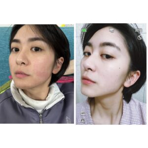 Chia-Wei Chu Instagram - 🔥醫美首次體驗就來個猛的(!)墨菲斯電波心得💓

這真的是我人生第一次施打醫美療程!有點緊張又興奮
首先會接觸這項產品是因為剛好是之前合作的廠商
有拍攝一部形象影片(不知道有沒有人看過了🤔)
再來是因為覺得自己的年紀也到了需要保養的時候
真的剛好天時地利人和耶🥺

做電波的效果好像是半年後才會開始明顯變化
原本想說 我臉上根本沒肉 應該沒什麼效果
目前術後一個月自己超級有感的地方居然是！！！
我的臉型對稱！！！！！！
不囉唆 大家直接看圖！！！
是不是真的有差！我認真嚇到😳😳
（沒想到還能校正臉型超讚的💓😍☺️

還不認識墨菲斯電波的～馬上幫大家懶人包科普：
墨菲斯電波顧名思義就是結合了「微針」與「電波」
利用微針破壞表皮和真皮組織
刺激皮膚再生反應
並藉由深入皮下的微針尖端持續釋放電波，加熱深層組織

而且墨菲斯電波是從肌膚底層釋放，加上探頭尖端擁有非絕緣設計，不會加熱到表皮，能更精準的加熱深層真皮層，可以安全地在組織中釋放更高的能量

墨菲斯不僅可以拉提下顎線條、緊緻肌膚
還能作用於凹痘疤下方的組織
改善月球表面🌕及痘疤、毛孔粗大的肌膚問題
也能藉由機器多種模式操作達到深層脂肪溶脂作用
探頭還有根據每個部位有不同的選擇塑形腹部、下巴和眼周都有對應的探頭⭐️客製化部分超加分

各個年齡階段都有在意的皮膚困境，
雖然已經被廠商說我的臉已經夠小了，但是小怎麼夠還要緊！💪🏼
墨菲斯電波能改善的狀況無論是痘疤、凹痕還是皺紋、鬆弛都是它的強項，經過肌膚破壞重組，刺激肌膚膠原蛋白增生❤️❤️

有3-5天修復期，但首次醫美的我都可以接受了😂
對其他人來說應該是小case🤗
後幾天要上班的朋朋盡量以淡妝為主唷👌🏼

這邊還要提醒一下，術後不建議冰敷，要讓電波持續作用～
冰敷有可能會影響到成效，所以多以加強保濕為主💦
（我過年瘋狂保濕🤣🤣 邊吃飯喝酒邊敷面膜🤣🤣
因為太荒謬直接被拍照紀念🤣🤣

如果你打過很多音波電波效果都不滿意
或是肌膚老化 但不想拉皮
以及有妊娠紋、在意橘皮者都很適合
聽說還是國外很多明星都在做的項目🔥🔥
#貝嫂 #小甜甜布蘭妮 
真心推薦大家可以試試看 #墨菲斯微針電波 😆

#墨菲斯微針電波 #微針電波 #墨菲斯電波 #inmode #醫美推薦 #電波推薦 ##morpheus8