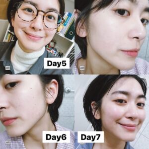 Chia-Wei Chu Instagram - 🔥醫美首次體驗就來個猛的(!)墨菲斯電波心得💓

這真的是我人生第一次施打醫美療程!有點緊張又興奮
首先會接觸這項產品是因為剛好是之前合作的廠商
有拍攝一部形象影片(不知道有沒有人看過了🤔)
再來是因為覺得自己的年紀也到了需要保養的時候
真的剛好天時地利人和耶🥺

做電波的效果好像是半年後才會開始明顯變化
原本想說 我臉上根本沒肉 應該沒什麼效果
目前術後一個月自己超級有感的地方居然是！！！
我的臉型對稱！！！！！！
不囉唆 大家直接看圖！！！
是不是真的有差！我認真嚇到😳😳
（沒想到還能校正臉型超讚的💓😍☺️

還不認識墨菲斯電波的～馬上幫大家懶人包科普：
墨菲斯電波顧名思義就是結合了「微針」與「電波」
利用微針破壞表皮和真皮組織
刺激皮膚再生反應
並藉由深入皮下的微針尖端持續釋放電波，加熱深層組織

而且墨菲斯電波是從肌膚底層釋放，加上探頭尖端擁有非絕緣設計，不會加熱到表皮，能更精準的加熱深層真皮層，可以安全地在組織中釋放更高的能量

墨菲斯不僅可以拉提下顎線條、緊緻肌膚
還能作用於凹痘疤下方的組織
改善月球表面🌕及痘疤、毛孔粗大的肌膚問題
也能藉由機器多種模式操作達到深層脂肪溶脂作用
探頭還有根據每個部位有不同的選擇塑形腹部、下巴和眼周都有對應的探頭⭐️客製化部分超加分

各個年齡階段都有在意的皮膚困境，
雖然已經被廠商說我的臉已經夠小了，但是小怎麼夠還要緊！💪🏼
墨菲斯電波能改善的狀況無論是痘疤、凹痕還是皺紋、鬆弛都是它的強項，經過肌膚破壞重組，刺激肌膚膠原蛋白增生❤️❤️

有3-5天修復期，但首次醫美的我都可以接受了😂
對其他人來說應該是小case🤗
後幾天要上班的朋朋盡量以淡妝為主唷👌🏼

這邊還要提醒一下，術後不建議冰敷，要讓電波持續作用～
冰敷有可能會影響到成效，所以多以加強保濕為主💦
（我過年瘋狂保濕🤣🤣 邊吃飯喝酒邊敷面膜🤣🤣
因為太荒謬直接被拍照紀念🤣🤣

如果你打過很多音波電波效果都不滿意
或是肌膚老化 但不想拉皮
以及有妊娠紋、在意橘皮者都很適合
聽說還是國外很多明星都在做的項目🔥🔥
#貝嫂 #小甜甜布蘭妮 
真心推薦大家可以試試看 #墨菲斯微針電波 😆

#墨菲斯微針電波 #微針電波 #墨菲斯電波 #inmode #醫美推薦 #電波推薦 ##morpheus8