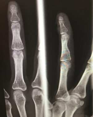 Claudia Black Instagram - Best valentines gift ever- a finger that is healing really well. Thanks for all the check ins and well wishes. I had given the finger the working title name of "2017" as the middle finger pretty much summed up that year though I'm thinking I may call her "Lucky" instead. The surgeons keep reminding me just how lucky I am-this could have been so very much worse. Way to reframe a big FU into something meaningful, positive and auspicious.