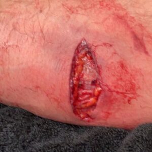 Daniel Wheeler Instagram - Graphic images: July 28th I had a hook stab into my arm and rip it to pieces. For a month I’ve struggled with grip strength, loss of feeling/nerve damage, and wondering if this is even worth it anymore. I don’t know if/when it’ll be back to 100% or if I’ll be back 100%. Maybe it holds up, maybe it doesn’t. But if this is the end, we’re getting revenge on the way out.