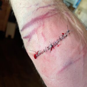 Daniel Wheeler Instagram - Graphic images: July 28th I had a hook stab into my arm and rip it to pieces. For a month I’ve struggled with grip strength, loss of feeling/nerve damage, and wondering if this is even worth it anymore. I don’t know if/when it’ll be back to 100% or if I’ll be back 100%. Maybe it holds up, maybe it doesn’t. But if this is the end, we’re getting revenge on the way out.
