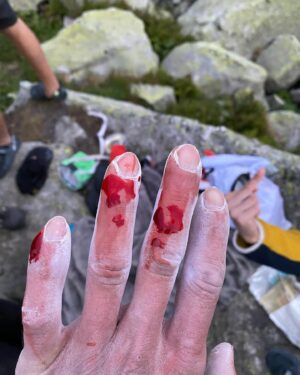 Daniel Woods Instagram - There will be blood

price u gotta pay sometimes in order to send. I mostly complain about my finger skin while climbing. The condition of it will truly make or break my confidence while trying hard. Such a small yet devastating injury 😂