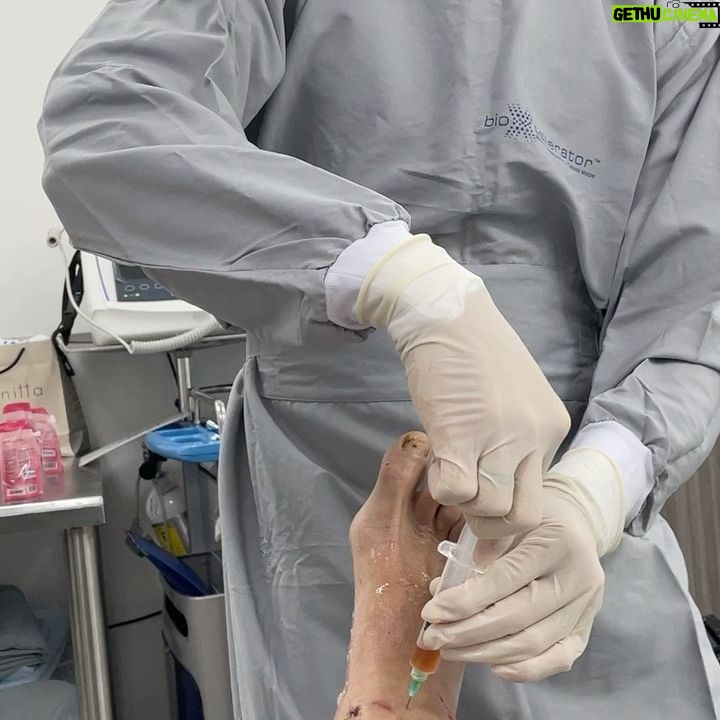 Danny Way - 14.5K Likes - Today I received @bioxcellerator_ mesenchymal stem cell injections in almost every joint in my body, I don’t like needles at all especially long ones that go deep into the joint but it’s worth every bit of the agony. I had fluid still lingering from my ankle and knee surgeries last week so they had to drain the fluid prior to injections which added a little extra pain to the game. The irony behind getting hurt is tough because you have to fight pain with pain or you will never get better, if I knew this as a kid I might of opted to follow another path but it’s way to late for that haha @doctor_alejo @dianis747 @joeygranath 📷📹