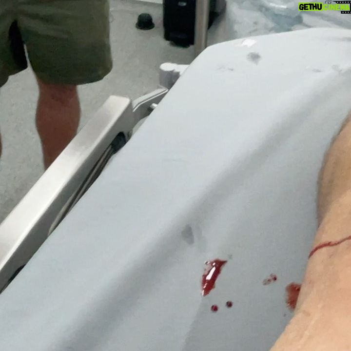 Danny Way - 14.5K Likes - Today I received @bioxcellerator_ mesenchymal stem cell injections in almost every joint in my body, I don’t like needles at all especially long ones that go deep into the joint but it’s worth every bit of the agony. I had fluid still lingering from my ankle and knee surgeries last week so they had to drain the fluid prior to injections which added a little extra pain to the game. The irony behind getting hurt is tough because you have to fight pain with pain or you will never get better, if I knew this as a kid I might of opted to follow another path but it’s way to late for that haha @doctor_alejo @dianis747 @joeygranath 📷📹