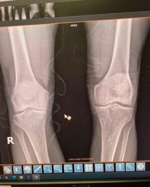 Danny Way Instagram - Seeing is believing, I’m always searching for the latest innovations with orthopedic medical science and was connected with @bioxcellerator_ through a good friend of mine @wolfmate about 2 years ago. I have had countless joint injuries and surgeries over the last 40 years and have some significant degeneration in several joints but the weight bearing joints are the most chronically painful. I have had 4 knee reconstructions on my left knee and about to have the 5th. Both of my knees have cartilage degeneration / arthritic changes from years of heavy abuse. BioXcellerator treated both knees along with every other joint in my body 14 months ago. Just prior to these treatments I had MRI scans and X-rays on every joint in my body. Here is proof of what the mesenchymal stem cells can do for degenerative joints. The first of these 2 films was shot 14 months by @dr.fabilus just prior to my treatment late June 2021 and the second film was shot 2 days ago September 9th 2022 by @dr.fabilus . The joint spacing has increased between my tibial plateau and my femoral condyle, which shows some level of cartilage regeneration in this 14 month time period and it will continue to improve for the next year or so! When I built this relationship with @bioxcellerator_ I told them I wanted to document the process and the results of my treatments and be completely transparent about the findings and they were so confident in the outcome they were happy for me to share the results. I’m so amazed by these results and very excited to be working with the most advanced scientists, doctors and business in the stem cell movement. Thank you so much @bioxcellerator_ @ericstoffers.ceo @dr.karolynnhalpert 
@dr_alejo 
@anahoyosf 
@dianis747 
@drwilliamprevite 
@dr.fabilus 
@anirpo90 
@joeygranath