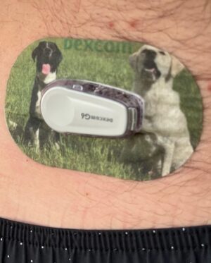 Derek Theler Instagram - Happy World Diabetes day! 
Talk about Instagram vs. reality! I wanted to show off my cool custom @pumppeelz patch cover on my @dexcom so I took the boys to the park. Cut to an hour later I was dealing with an urgent low. This is a real #seediabetes moment. It’s a good lesson that your glucose doesn’t always cooperate, and you gotta roll with the punches. 
 
I definitely chose the right team for the patch since they help me so much through my lows. Thanks Dexcom for the alert so I could treat the low before it got worse! 
 
#seediabetes #forwardas1 #worlddiabetesday #sponsored 
 
* Smart devices sold separately. For a list of compatible smart devices, visit @Dexcom’s link in bio