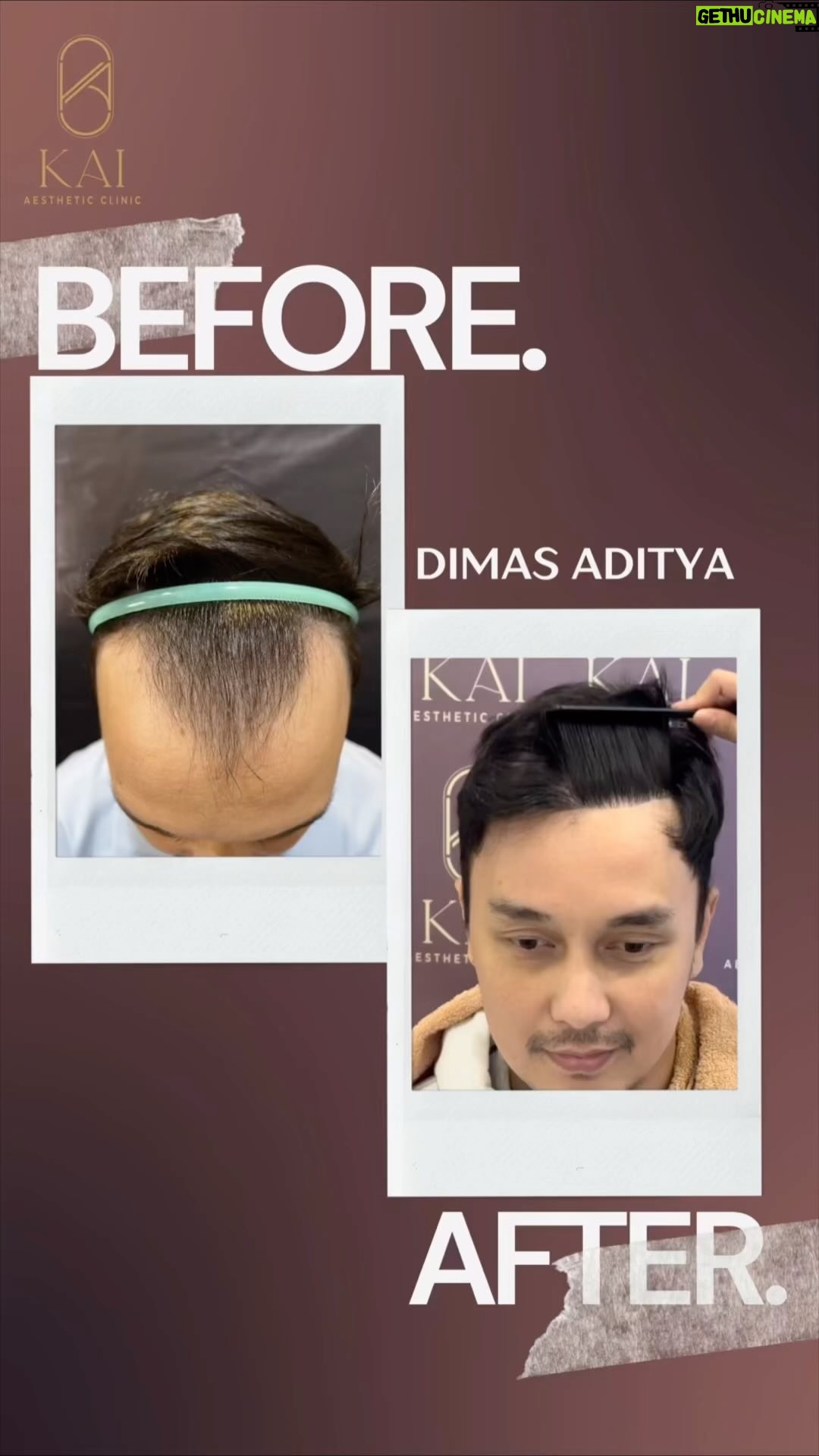 Dimas Aditya - 821 Likes - Thank you @dimsad77 for trusting us to help you achieve your dream hair✨
Ready for a hair transplant transformation? Say goodbye to thinning hair and hello to confidence!✨ no more hats or wigs, no more hiding. Just natural, healthy hair that’s yours. Don’t let baldness hold you back any longer. Take the first step towards a new you today!✨
Reservations: 0811 111 5667
#kaiaesthetic #beautyjournal #kaigrow #hairloss #hairjourney #hairtreatment #klinikjakarta #hairclinic #jktinfo #hairtransplant #tanamrambut #beardimplant #hairrestoration #hairtransplantkemang #hairtransplantjakarta