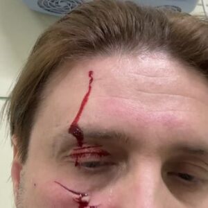 Edgard Zapashnyy Instagram - The first video I recorded shortly before my injury. There I’m sitting with Roy and one day later he hooked me exactly his left paw!
 If you have claws, sometimes you can use them 😁
 Roy is not to blame, it’s only my mistake - I was distracted at the wrong time and didn’t t see how Roy jumped from another tiger in my direction.
Sometimes it happens - it's just an accident.
Roy I love you ❤️ 

Первое видео я записал незадолго до своей травмы. Именно на нем я сижу вместе с Роем, и зацепил он меня как раз этой самой левой лапой !
Раз когти есть, то ими можно иногда пользоваться 😁
Рой не виноват,виноват я сам - отвлекся не вовремя и не увидел, как Рой отпрыгнул от другого тигра в мою сторону.
Такое бывает - просто несчастный случай.
Роя люблю и дальше ❤️

#ялюблютебяжизнь #такаяработа #запашный #цирк#circusaccident #zapashnybrotherscircus #roy #mytiger #shithappens