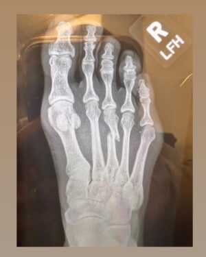 Emily Whitmire Instagram - Post surgery! I feel great! I’m kind of surprised how good I feel. Thank you so much to everyone for being so sweet and supportive. I feel so grateful for the people in my life. This is just a small set back. Looking forward to recovering and getting back on the mat. #surgery #fightlife #comeback #comingsoon #grateful